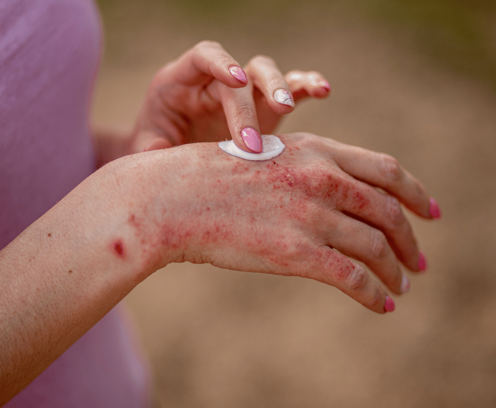 Probioticele Symprove™ ca ajutor în lupta cu eczema atopică