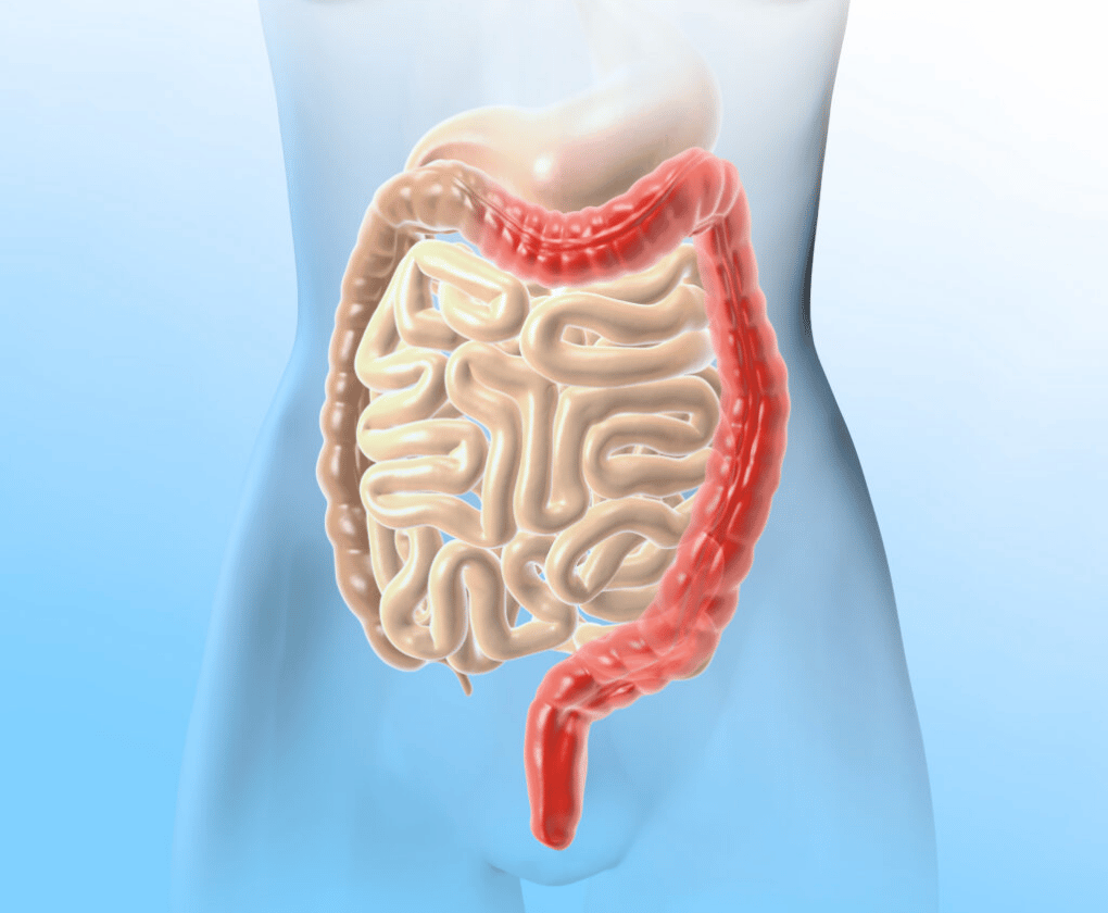 Colita ulcerativă - ce este, simptome, diagnostic și tratament
