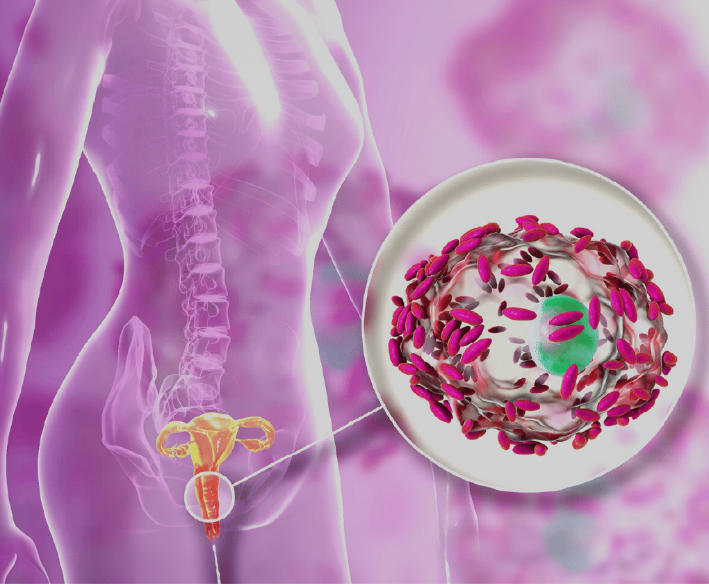 Vaginoza bacteriană la femei și tratamentul ei cu probiotice