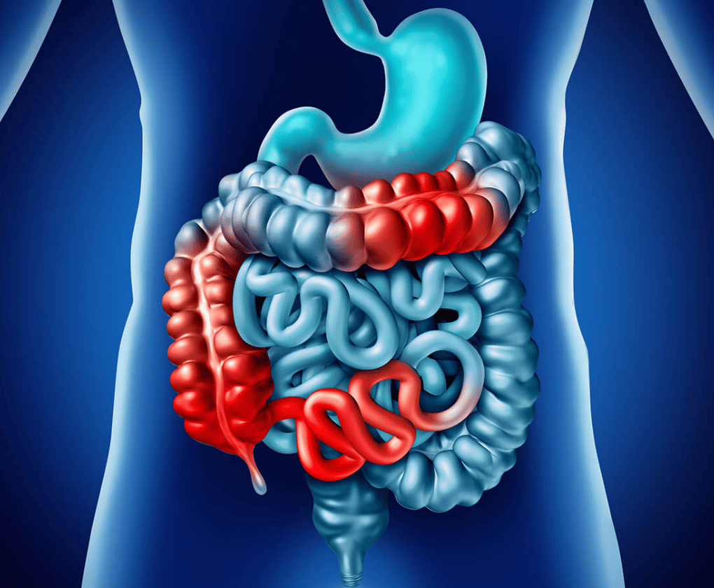 Boala Crohn - o boală cronică ce nu poate fi vindecată complet