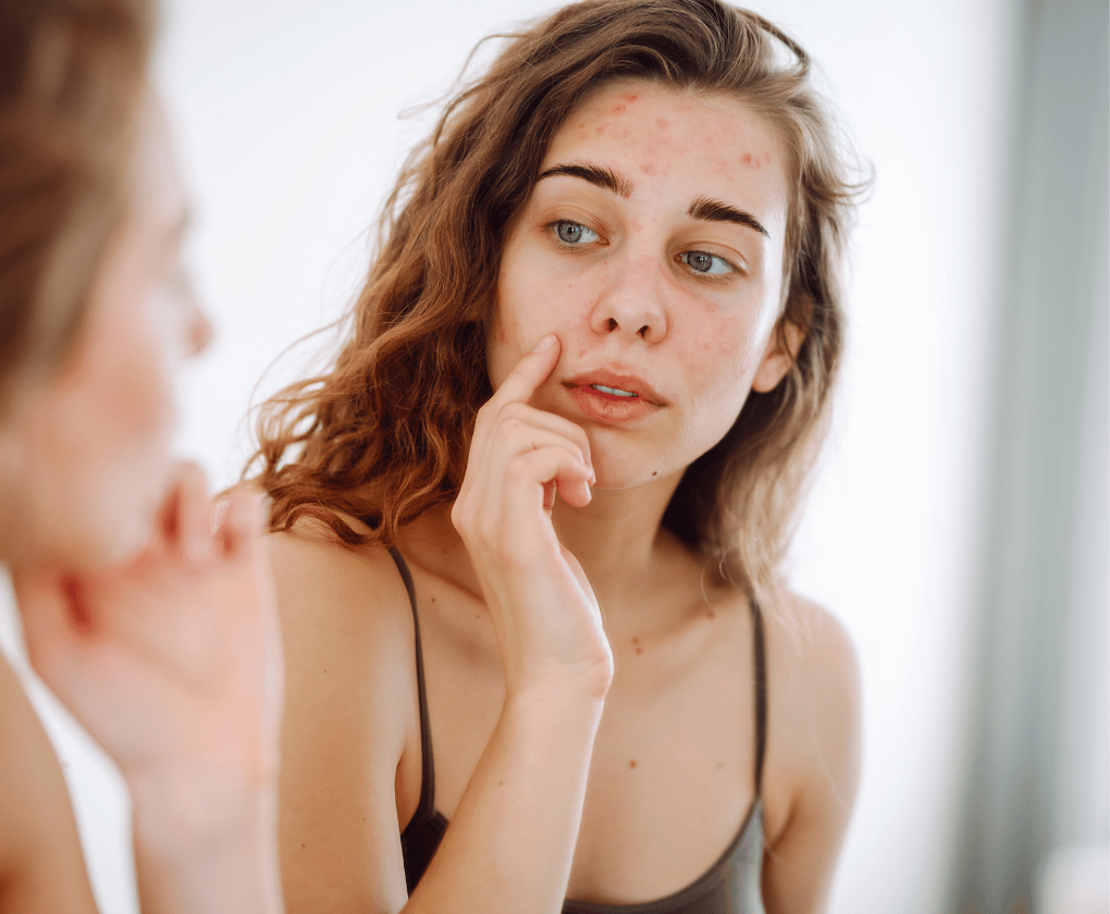 Piele iritată sau acnee. Ce influență are microbiomul asupra sănătății pielii?