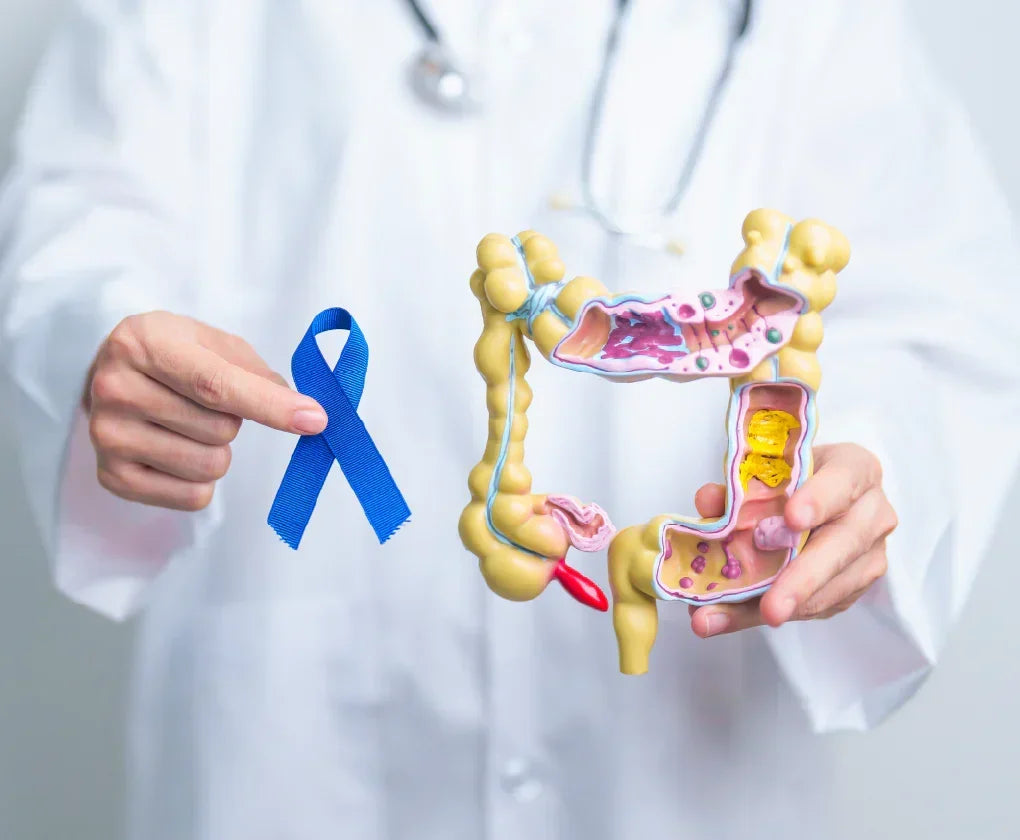 Cancerul de colon și rect – Cum apare și cum îl putem preveni?
